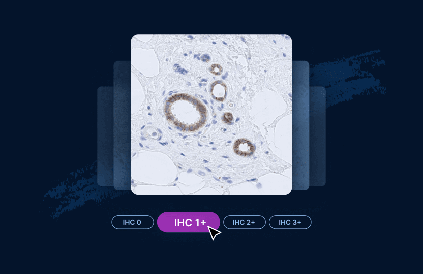 Practice your HER2 IHC scoring with clinical cases selected by our Pathology Faculty